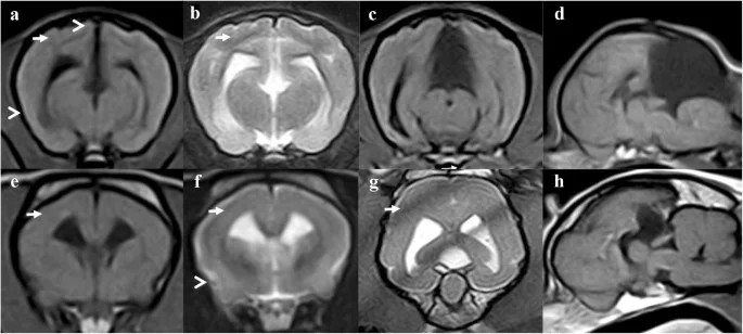 Lissencephaly 